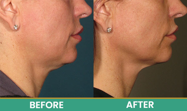 Before & After at Aspire Medical Aesthetics in Scarsdale & New York, NY