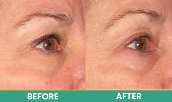 Before & After at Aspire Medical Aesthetics in Scarsdale & New York, NY