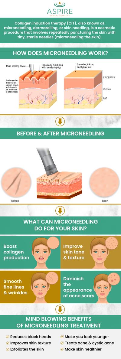 Microneedling is a minimally invasive treatment for fine lines, wrinkles, acne scars, stretch marks, and pigmentation disorders. Microneedling stimulates collagen synthesis, which rejuvenates the skin and makes it appear younger and more natural. Tiny needles from micro-needling devices stimulate collagen formation throughout this process, keeping the skin tight and firm. Our aesthetic professionals help you reclaim your smooth skin. Learn the benefits of microneedling and how it helps combat aging skin at Aspire Medical Aesthetics. For more information, contact us today or schedule an appointment online. We have convenient locations to serve you in Scarsdale NY, and New York, NY.