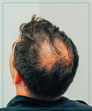 PRF & Gallery at Aspire Medical Aesthetics in Scarsdale and New York, NY