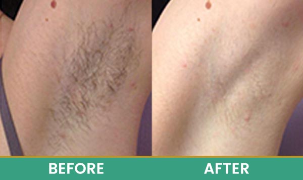 Before & After at Aspire Medical Aesthetics in Scarsdale & New York, NY Before & After at Aspire Medical Aesthetics in Scarsdale & New York, NY