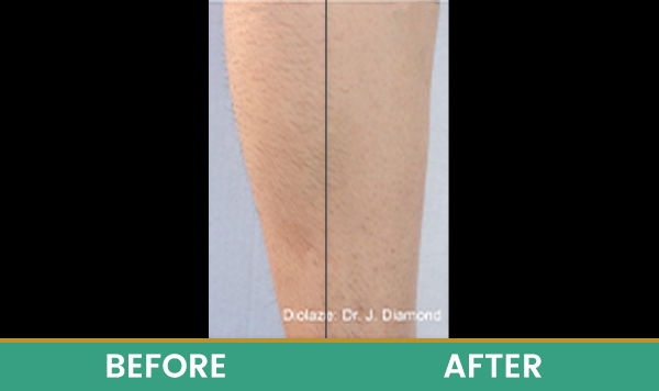 Before & After at Aspire Medical Aesthetics in Scarsdale & New York, NY Before & After at Aspire Medical Aesthetics in Scarsdale & New York, NY