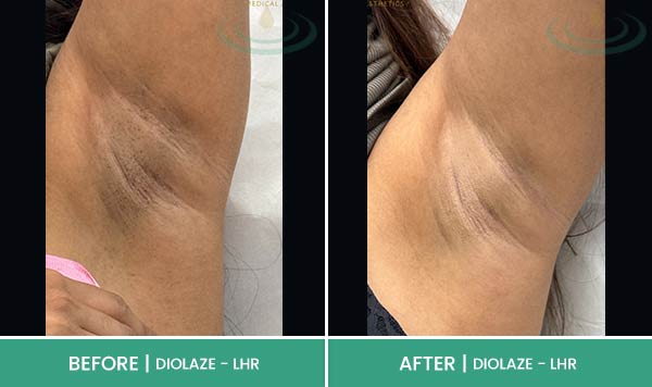 Before & After at Aspire Medical Aesthetics in Scarsdale & New York, NY Before & After at Aspire Medical Aesthetics in Scarsdale & New York, NY