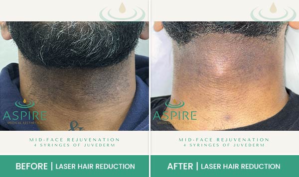 Before & After at Aspire Medical Aesthetics in Scarsdale & New York, NY Before & After at Aspire Medical Aesthetics in Scarsdale & New York, NY