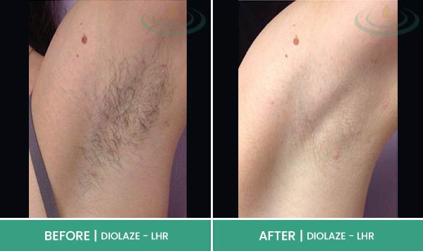 Before & After at Aspire Medical Aesthetics in Scarsdale & New York, NY Before & After at Aspire Medical Aesthetics in Scarsdale & New York, NY