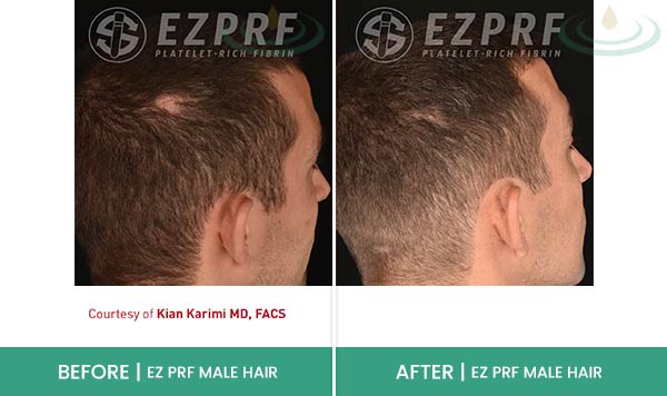 Before & After at Aspire Medical Aesthetics in Scarsdale & New York, NY Before & After at Aspire Medical Aesthetics in Scarsdale & New York, NY