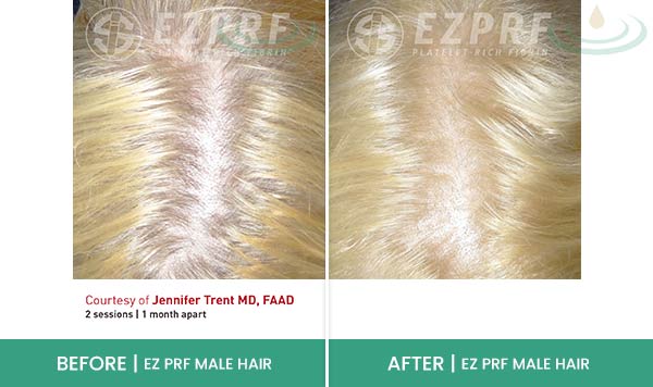 Before & After at Aspire Medical Aesthetics in Scarsdale & New York, NY Before & After at Aspire Medical Aesthetics in Scarsdale & New York, NY