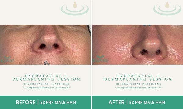 Before & After at Aspire Medical Aesthetics in Scarsdale & New York, NY Before & After at Aspire Medical Aesthetics in Scarsdale & New York, NY