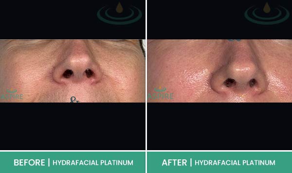 Before & After at Aspire Medical Aesthetics in Scarsdale & New York, NY Before & After at Aspire Medical Aesthetics in Scarsdale & New York, NY