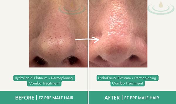 Before & After at Aspire Medical Aesthetics in Scarsdale & New York, NY Before & After at Aspire Medical Aesthetics in Scarsdale & New York, NY