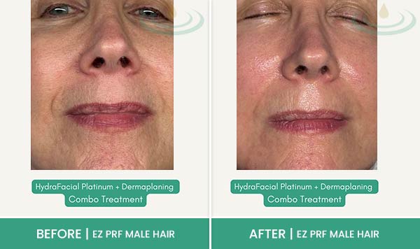 Before & After at Aspire Medical Aesthetics in Scarsdale & New York, NY Before & After at Aspire Medical Aesthetics in Scarsdale & New York, NY