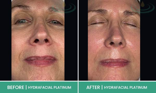 Before & After at Aspire Medical Aesthetics in Scarsdale & New York, NY Before & After at Aspire Medical Aesthetics in Scarsdale & New York, NY