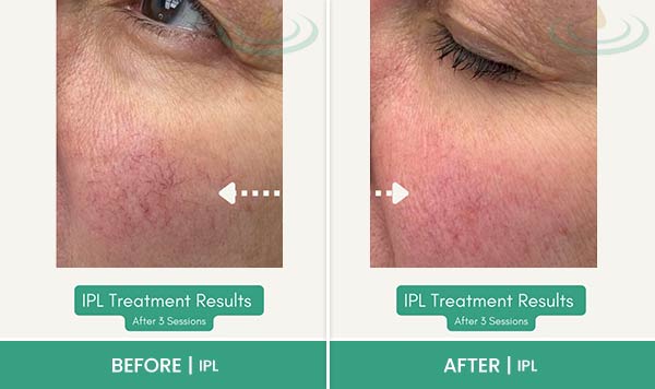 Before & After at Aspire Medical Aesthetics in Scarsdale & New York, NY Before & After at Aspire Medical Aesthetics in Scarsdale & New York, NY