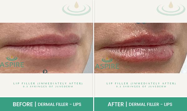 Before & After at Aspire Medical Aesthetics in Scarsdale & New York, NY Before & After at Aspire Medical Aesthetics in Scarsdale & New York, NY