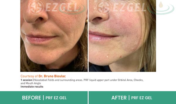 Before & After at Aspire Medical Aesthetics in Scarsdale & New York, NY Before & After at Aspire Medical Aesthetics in Scarsdale & New York, NY
