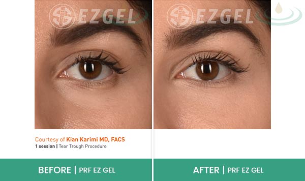 Before & After at Aspire Medical Aesthetics in Scarsdale & New York, NY Before & After at Aspire Medical Aesthetics in Scarsdale & New York, NY