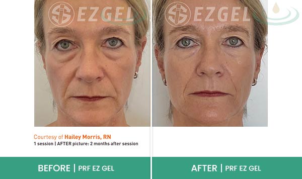 Before & After at Aspire Medical Aesthetics in Scarsdale & New York, NY Before & After at Aspire Medical Aesthetics in Scarsdale & New York, NY