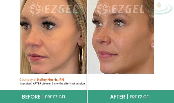 Before & After at Aspire Medical Aesthetics in Scarsdale & New York, NY Before & After at Aspire Medical Aesthetics in Scarsdale & New York, NY