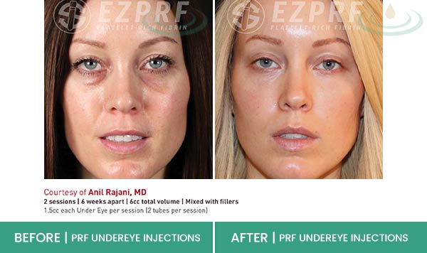 Before & After at Aspire Medical Aesthetics in Scarsdale & New York, NY Before & After at Aspire Medical Aesthetics in Scarsdale & New York, NY