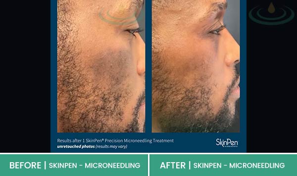 Before & After at Aspire Medical Aesthetics in Scarsdale & New York, NY Before & After at Aspire Medical Aesthetics in Scarsdale & New York, NY