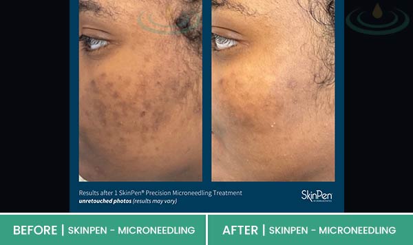 Before & After at Aspire Medical Aesthetics in Scarsdale & New York, NY Before & After at Aspire Medical Aesthetics in Scarsdale & New York, NY
