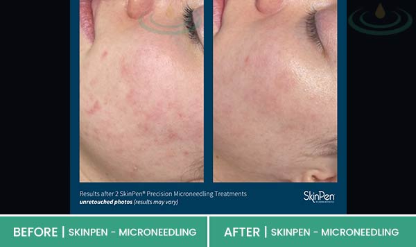 Before & After at Aspire Medical Aesthetics in Scarsdale & New York, NY Before & After at Aspire Medical Aesthetics in Scarsdale & New York, NY