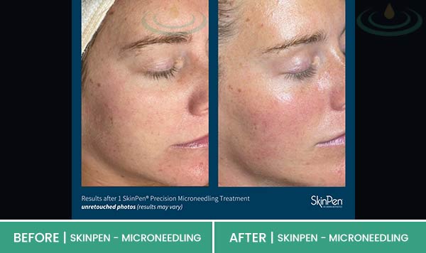 Before & After at Aspire Medical Aesthetics in Scarsdale & New York, NY Before & After at Aspire Medical Aesthetics in Scarsdale & New York, NY