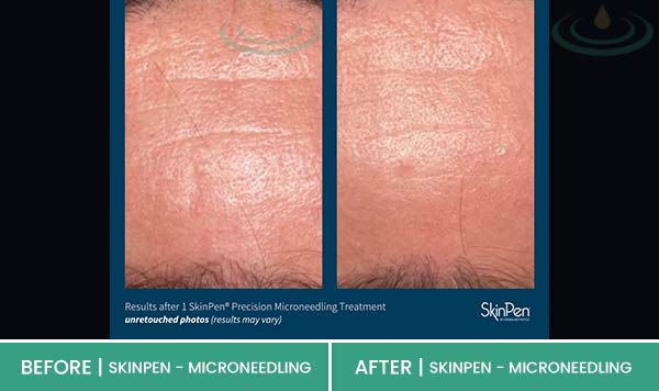 Before & After at Aspire Medical Aesthetics in Scarsdale & New York, NY Before & After at Aspire Medical Aesthetics in Scarsdale & New York, NY
