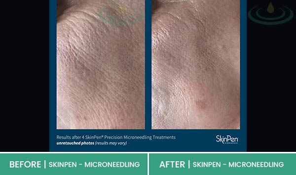 Before & After at Aspire Medical Aesthetics in Scarsdale & New York, NY Before & After at Aspire Medical Aesthetics in Scarsdale & New York, NY