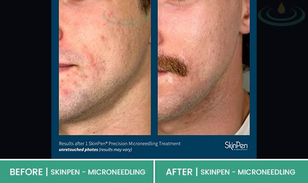 Before & After at Aspire Medical Aesthetics in Scarsdale & New York, NY Before & After at Aspire Medical Aesthetics in Scarsdale & New York, NY