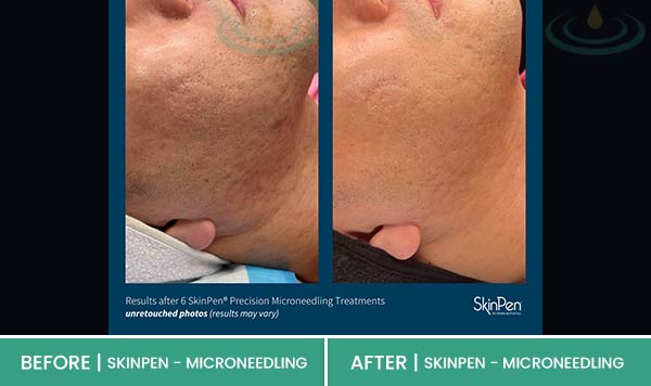 Before & After at Aspire Medical Aesthetics in Scarsdale & New York, NY Before & After at Aspire Medical Aesthetics in Scarsdale & New York, NY