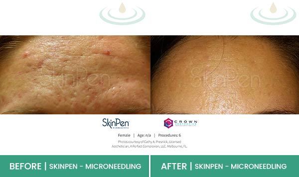Before & After at Aspire Medical Aesthetics in Scarsdale & New York, NY Before & After at Aspire Medical Aesthetics in Scarsdale & New York, NY