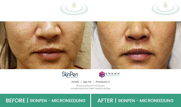 Before & After at Aspire Medical Aesthetics in Scarsdale & New York, NY Before & After at Aspire Medical Aesthetics in Scarsdale & New York, NY
