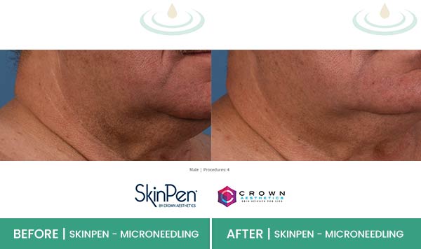 Before & After at Aspire Medical Aesthetics in Scarsdale & New York, NY Before & After at Aspire Medical Aesthetics in Scarsdale & New York, NY