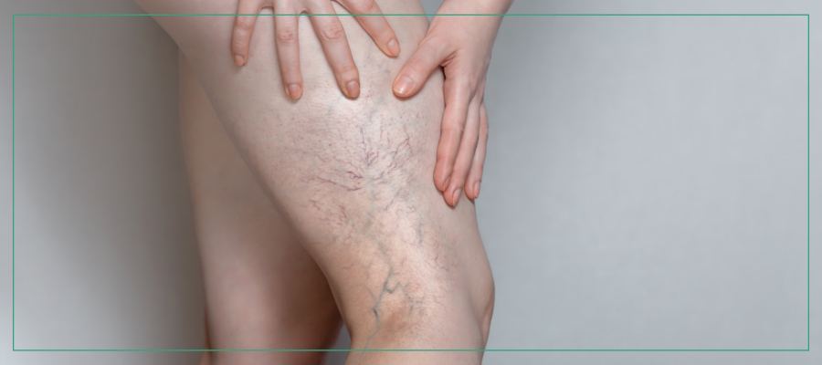 What to Expect Before and After Sclerotherapy | Aspire Medical Aesthetics Near Me in Scarsdale and New York, NY What to Expect Before and After Sclerotherapy | Aspire Medical Aesthetics Near Me in Scarsdale and New York, NY