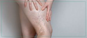 What to Expect Before and After Sclerotherapy | Aspire Medical Aesthetics Near Me in Scarsdale and New York, NY What to Expect Before and After Sclerotherapy | Aspire Medical Aesthetics Near Me in Scarsdale and New York, NY
