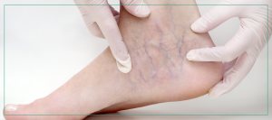 Benefits of Sclerotherapy for Vein Treatment | Aspire Medical Aesthetics Near Me in Scarsdale and New York, NY