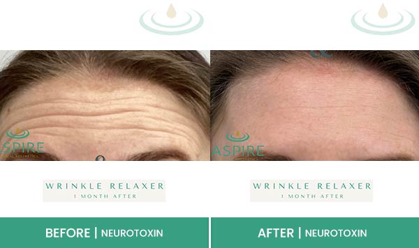 Before & After at Aspire Medical Aesthetics in Scarsdale & New York, NY Before & After at Aspire Medical Aesthetics in Scarsdale & New York, NY