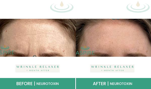 Before & After at Aspire Medical Aesthetics in Scarsdale & New York, NY Before & After at Aspire Medical Aesthetics in Scarsdale & New York, NY