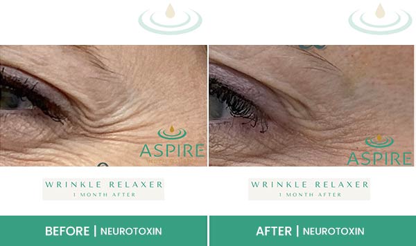 Before & After at Aspire Medical Aesthetics in Scarsdale & New York, NY Before & After at Aspire Medical Aesthetics in Scarsdale & New York, NY