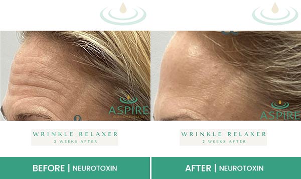 Before & After at Aspire Medical Aesthetics in Scarsdale & New York, NY Before & After at Aspire Medical Aesthetics in Scarsdale & New York, NY