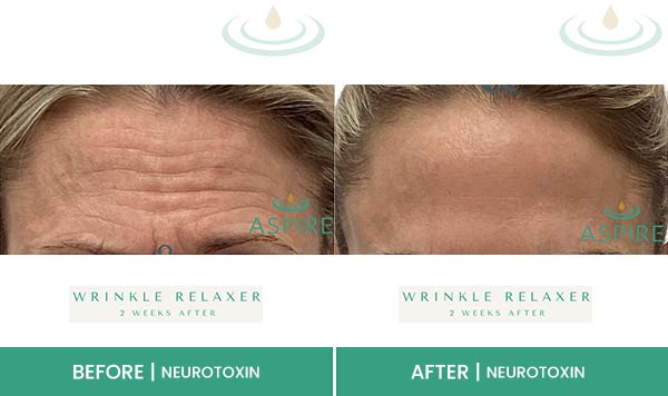 Before & After at Aspire Medical Aesthetics in Scarsdale & New York, NY Before & After at Aspire Medical Aesthetics in Scarsdale & New York, NY