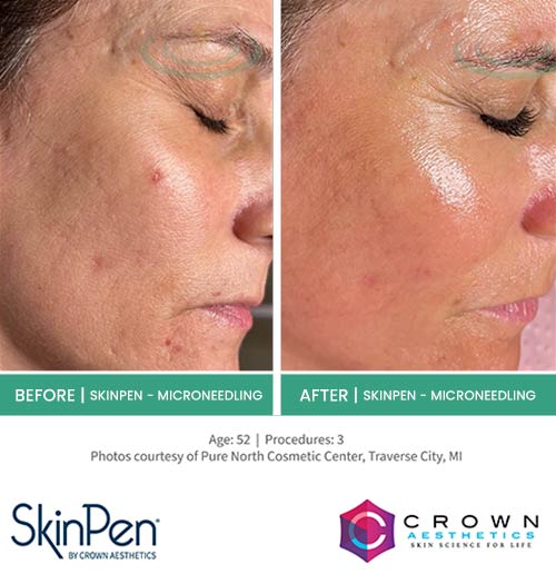 Before & After at Aspire Medical Aesthetics in Scarsdale & New York, NY Before & After at Aspire Medical Aesthetics in Scarsdale & New York, NY