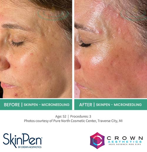 Before & After at Aspire Medical Aesthetics in Scarsdale & New York, NY Before & After at Aspire Medical Aesthetics in Scarsdale & New York, NY