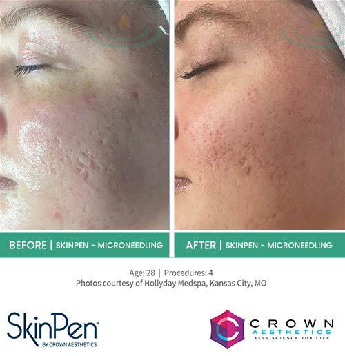 Before & After at Aspire Medical Aesthetics in Scarsdale & New York, NY Before & After at Aspire Medical Aesthetics in Scarsdale & New York, NY
