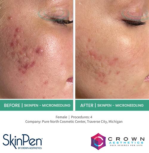 Before & After at Aspire Medical Aesthetics in Scarsdale & New York, NY Before & After at Aspire Medical Aesthetics in Scarsdale & New York, NY
