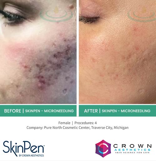 Before & After at Aspire Medical Aesthetics in Scarsdale & New York, NY Before & After at Aspire Medical Aesthetics in Scarsdale & New York, NY