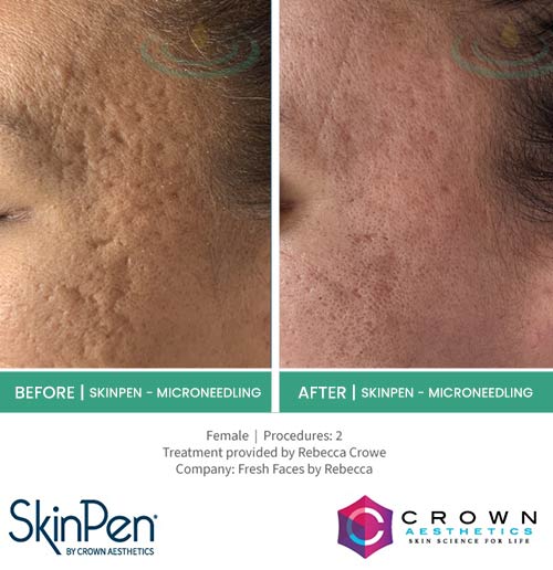 Before & After at Aspire Medical Aesthetics in Scarsdale & New York, NY Before & After at Aspire Medical Aesthetics in Scarsdale & New York, NY