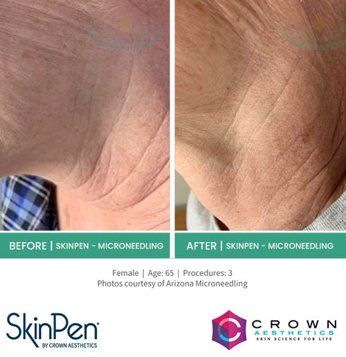 Before & After at Aspire Medical Aesthetics in Scarsdale & New York, NY Before & After at Aspire Medical Aesthetics in Scarsdale & New York, NY