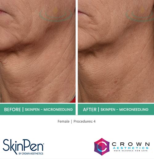 Before & After at Aspire Medical Aesthetics in Scarsdale & New York, NY Before & After at Aspire Medical Aesthetics in Scarsdale & New York, NY